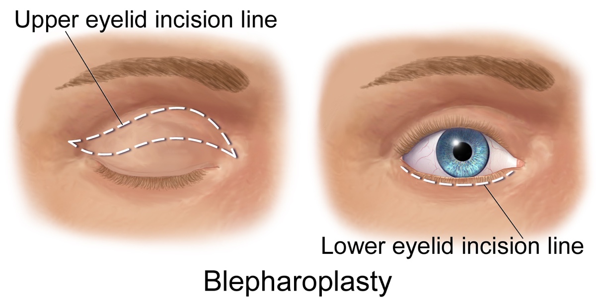 Medical illustration of eyelid surgery (blepharoplasty)