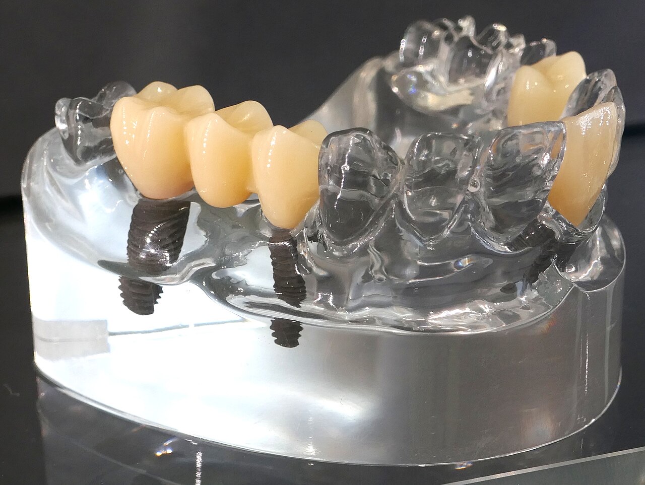 Dental implant model showing implant screws and crown