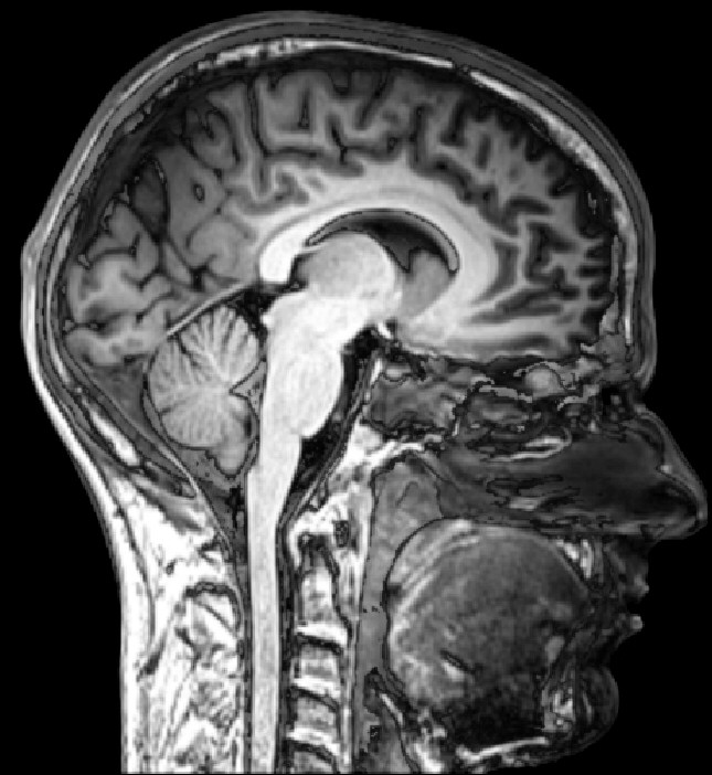 MRI scan of a human head in sagittal section