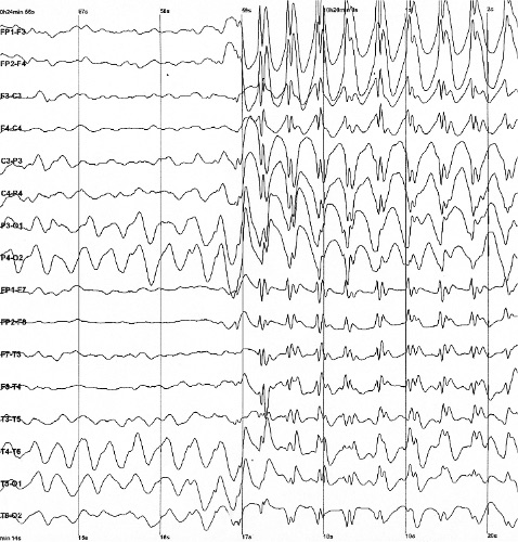 EEG trace showing generalized 3 Hz spike-and-wave discharges