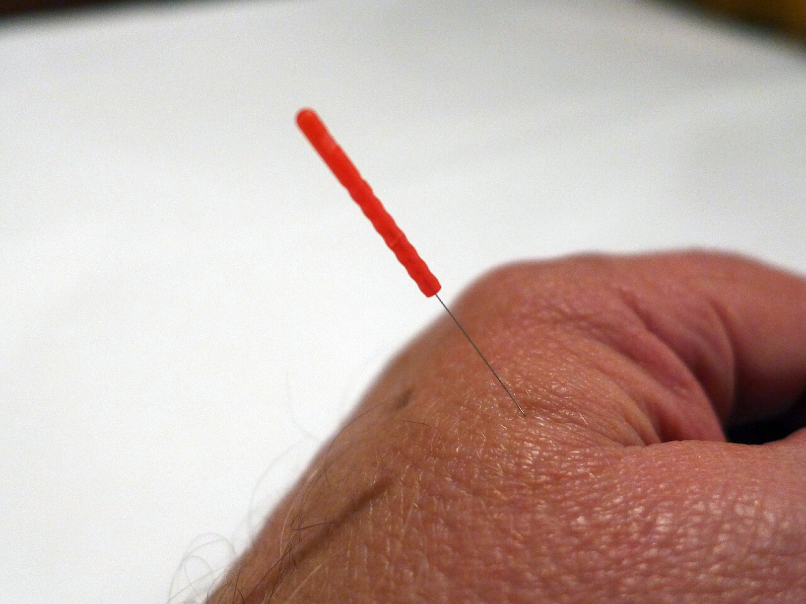 Acupuncture needles inserted in the back of a hand